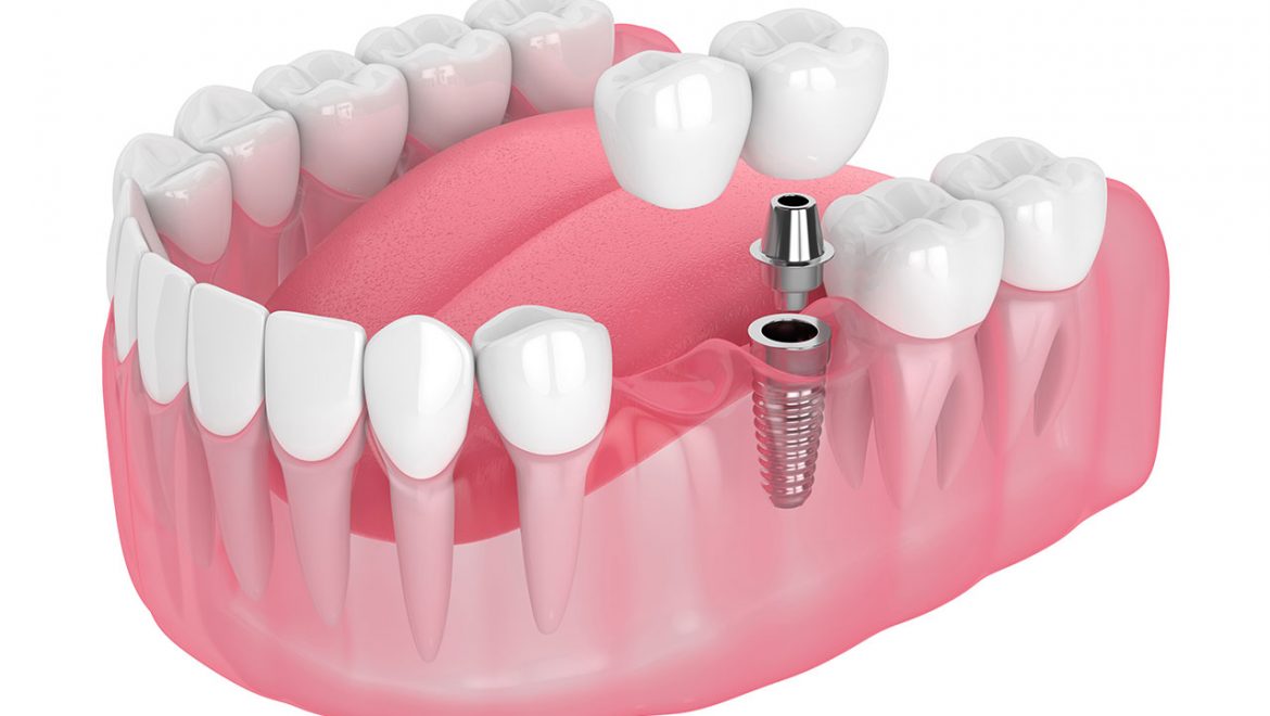 Sind Zahnimplantate geeignet, wenn nichts mehr hilft?